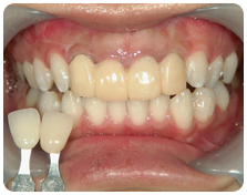 仮歯+ホワイトニング
